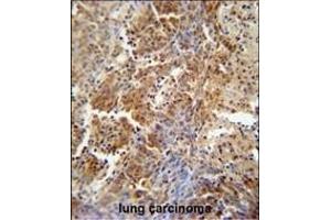 ERCC8 antibody (Center) (ABIN654909 and ABIN2844556) immunohistochemistry analysis in formalin fixed and paraffin embedded human lung carcinoma followed by peroxidase conjugation of the secondary antibody and DAB staining.