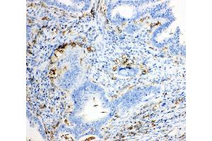 Anti-TRPC6 antibody, IHC(P) IHC(P): Human Intestinal Cancer Tissue (TRPC6 抗体  (Middle Region))