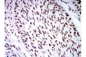 Immunohistochemical analysis of paraffin-embedded esophageal cancer tissues using ZFP91 mouse mAb with DAB staining. (ZFP91 抗体  (AA 162-304))