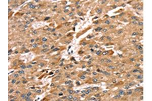 The image on the left is immunohistochemistry of paraffin-embedded Human liver cancer tissue using ABIN7192291(SDC3 Antibody) at dilution 1/30, on the right is treated with synthetic peptide. (SDC3 抗体)