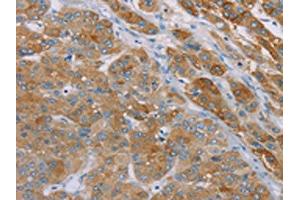 The image on the left is immunohistochemistry of paraffin-embedded Human liver cancer tissue using ABIN7192256(SAMD4A Antibody) at dilution 1/30, on the right is treated with synthetic peptide. (SAMD4A 抗体)
