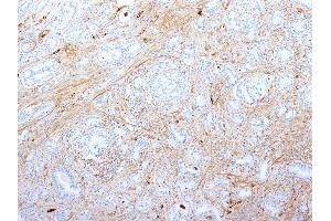 Formalin-fixed, paraffin-embedded human Pancreatic Adenocarcinoma stained with Fibronectin Monoclonal Antibody (SPM539). (Fibronectin 1 抗体)