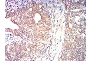 Immunohistochemical analysis of paraffin-embedded cervical cancer tissues using MAP3K14 mouse mAb with DAB staining. (MAP3K14 抗体  (AA 769-947))