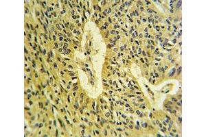 SMAD7 antibody IHC analysis in formalin fixed and paraffin embedded lung carcinoma. (SMAD7 抗体  (AA 195-224))
