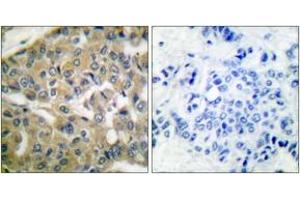 Immunohistochemistry analysis of paraffin-embedded human breast carcinoma tissue, using FHIT Antibody. (FHIT 抗体  (AA 81-130))