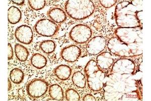 Immunohistochemical analysis of paraffin-embedded Human Colon Carcinoma Tissue using Acetyl P53(K382) Mouse mAb diluted at 1:2000 (p53 抗体  (acLys382))