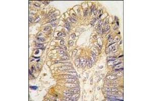 Formalin-fixed and paraffin-embedded human colon carcinoma tissue reacted with CLIC5 antibody, which was peroxidase-conjugated to the secondary antibody, followed by DAB staining. (CLIC5 抗体)