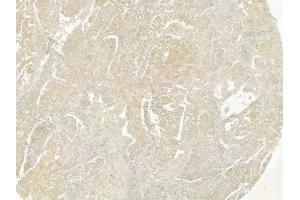 ABIN6259331 and ABIN6275349 at 1/100 staining human lung squamous cell carcinoma by IHC-P. (PEX14 抗体  (Internal Region))