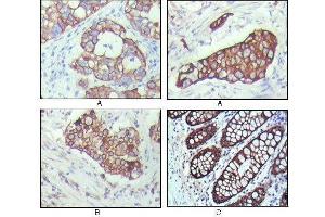 Immunohistochemical analysis of paraffin-embedded human breast carcinoma(A), lung cancer(B) and normal colon tissue(C), showing cytoplasmic localization with DAB staining using KRT19 mouse mAb.