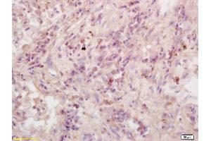 Formalin-fixed and paraffin embedded human lung carcinoma labeled with Anti-RASSF1A Polyclonal Antibody, Unconjugated (ABIN673764) at 1:200 followed by conjugation to the secondary antibody and DAB staining. (RASSF1 抗体  (AA 145-260))