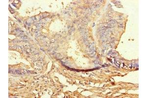 Immunohistochemistry of paraffin-embedded human endometrial cancer using ABIN7160080 at dilution of 1:100 (BUB1B 抗体  (AA 230-394))