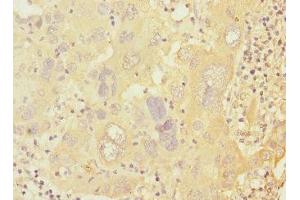 Immunohistochemistry of paraffin-embedded human liver cancer using ABIN7146619 at dilution of 1:100 (PRKAR1B 抗体  (Regulatory Subunit))