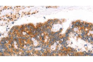 Immunohistochemistry of paraffin-embedded Human colon cancer tissue using AFDN Polyclonal Antibody at dilution 1:40 (Afadin 抗体)