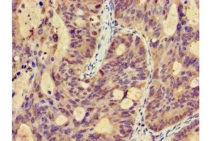 Immunohistochemistry of paraffin-embedded human colon cancer using ABIN7146326 at dilution of 1:100 (EFHA1 抗体  (AA 26-247))