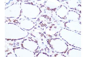 Immunohistochemistry of paraffin-embedded human thyroid cancer using Lamin B2 Rabbit mAb (ABIN1679310, ABIN3019324, ABIN3019325 and ABIN7101750) at dilution of 1:100 (40x lens).