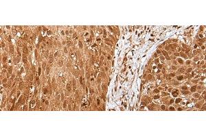 Immunohistochemistry of paraffin-embedded Human lung cancer tissue using UBA7 Polyclonal Antibody at dilution of 1:35(x200) (UBA7 抗体)