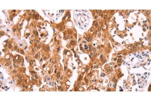 Immunohistochemistry of paraffin-embedded Human lung cancer using NCEH1 Polyclonal Antibody at dilution of 1:80 (NCEH1 抗体)
