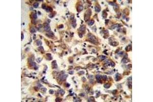 TFAM antibody immunohistochemistry analysis in formalin fixed and paraffin embedded human testis carcinoma.