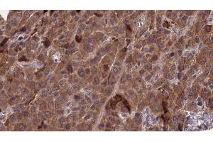 ABIN6277268 at 1/100 staining Human liver cancer tissue by IHC-P. (PAK1 抗体  (N-Term))
