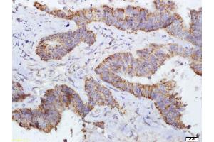 Paraformaldehyde-fixed, paraffin embedded Human colon cancer Antigen retrieval by boiling in sodium citrate buffer (pH6. (DERL1 抗体  (AA 111-220))