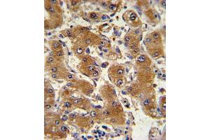 Formalin-fixed and paraffin-embedded human hepatocarcinoma with COL6A1 Antibody (C-term), which was peroxidase-conjugated to the secondary antibody, followed by DAB staining. (COL6A1 抗体  (C-Term))