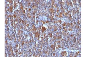 Formalin-fixed, paraffin-embedded Hodgkin's Lymphoma stained with BAX Mouse Monoclonal Antibody (BAX/962).