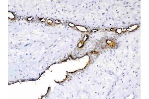 IHC analysis of MUC1 using anti-MUC1 antibody . (MUC1 抗体  (AA 1062-1139))
