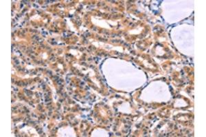 The image on the left is immunohistochemistry of paraffin-embedded Human thyroid cancer tissue using ABIN7129127(CYP1B1 Antibody) at dilution 1/20, on the right is treated with fusion protein. (CYP1B1 抗体)