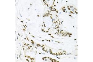 Immunohistochemistry of paraffin-embedded human gastric cancer using MAPK8 antibody (ABIN5970116) at dilution of 1/100 (40x lens).