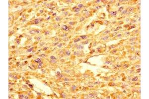 Immunohistochemistry of paraffin-embedded human melanoma using ABIN7154300 at dilution of 1:100 (GOLPH3L 抗体  (AA 6-285))