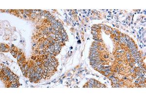 Immunohistochemistry of paraffin-embedded Human colon cancer tissue using Claudin 10 Polyclonal Antibody at dilution 1:50 (CLDN10 抗体)
