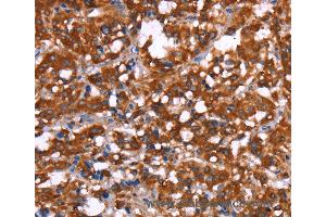 Immunohistochemistry of Human gastric cancer using GAGE12I Polyclonal Antibody at dilution of 1:30 (G Antigen 12I 抗体)