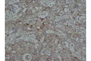Immunohistochemical analysis of parafin-embedded human intestine cancer tissue sections using SMAD2/3 antibody (SMAD2 抗体  (N-Term))