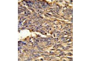 Formalin-fixed and paraffin-embedded human lung carcinoma reacted with HBA2 Antibody (Center) followed which was peroxidase-conjugated to the secondary antibody, followed by DAB staining. (HBA1 抗体  (Middle Region))