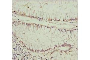 Immunohistochemistry of paraffin-embedded human colon cancer using ABIN7163634 at dilution of 1:100 (PDGFRL 抗体  (AA 15-205))