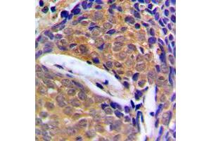 Immunohistochemical analysis of Cystatin B staining in human breast cancer formalin fixed paraffin embedded tissue section. (CSTB 抗体  (Center))