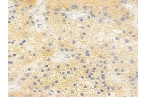 ABIN6264089 and ABIN6279283 at 1/100 staining human hepatocellular carcinoma by IHC-P. (PDE2A 抗体  (C-Term))