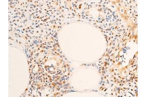 Immunohistochemistry (IHC) image for anti-Receptor tyrosine-protein kinase erbB-2 (ErbB2/Her2) (pTyr1248) antibody (ABIN6256630)