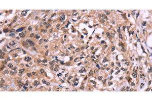 Immunohistochemistry of paraffin-embedded Human esophagus cancer using AMIGO2 Polyclonal Antibody at dilution of 1:50 (AMIGO2 抗体)