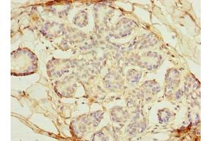 Immunohistochemistry of paraffin-embedded human breast cancer using ABIN7162370 at dilution of 1:100 (OSGIN2 抗体  (AA 1-250))