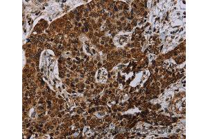 Immunohistochemistry of Human liver cancer using NDUFA4 Polyclonal Antibody at dilution of 1:40 (NDUFA4 抗体)