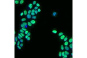 Immunofluorescent staining of human breast adenocarcinoma. (GATA3 抗体)