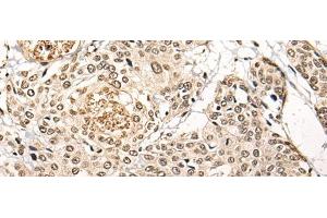 Immunohistochemistry of paraffin-embedded Human prost ate cancer tissue using BATF Polyclonal Antibody at dilution of 1:45(x200) (BATF 抗体)