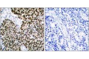 Immunohistochemistry analysis of paraffin-embedded human breast carcinoma tissue, using HSF1 (Ab-303) Antibody. (HSF1 抗体  (AA 270-319))