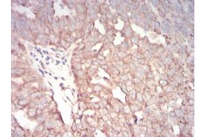 Immunohistochemical analysis of paraffin-embedded ovarian cancer tissues using TFAP2A mouse mAb with DAB staining.