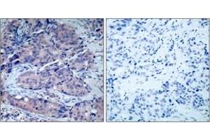 Immunohistochemistry analysis of paraffin-embedded human breast carcinoma tissue, using SEK1/MKK4 (Ab-261) Antibody. (MAP2K4 抗体  (AA 227-276))