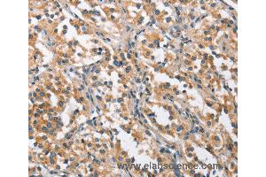 Immunohistochemistry of Human thyroid cancer using CHMP1A Polyclonal Antibody at dilution of 1:60 (CHMP1A 抗体)