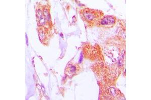 Immunohistochemical analysis of Involucrin staining in human lung cancer formalin fixed paraffin embedded tissue section. (Involucrin 抗体  (C-Term))