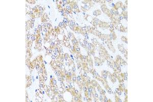 Immunohistochemistry of paraffin-embedded human liver injury using CHD1 antibody at dilution of 1:100 (x40 lens). (CHD1 抗体)