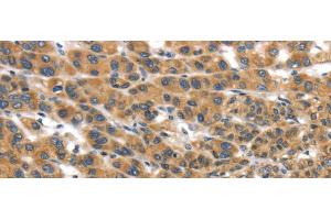 Immunohistochemistry of paraffin-embedded Human liver cancer tissue using UBTD2 Polyclonal Antibody at dilution 1:35 (UBTD2 抗体)